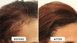 Hairline Lowering - best treatment